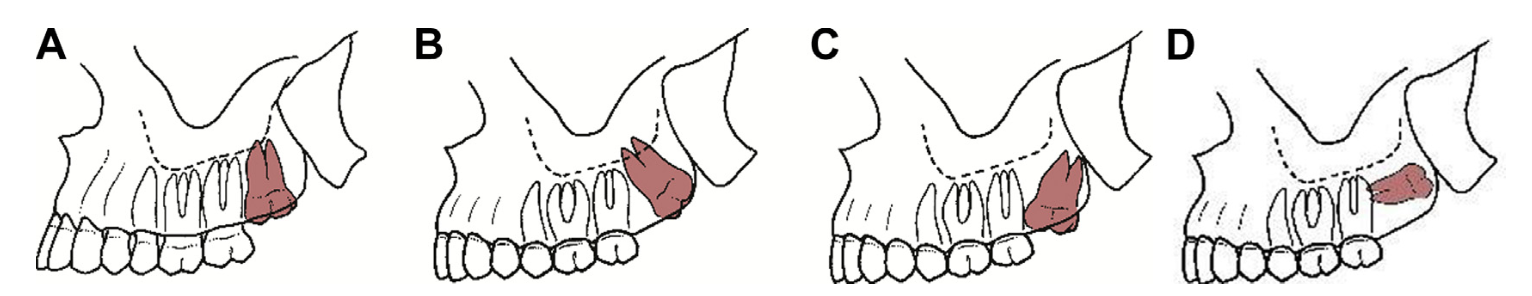 third molar impaction types